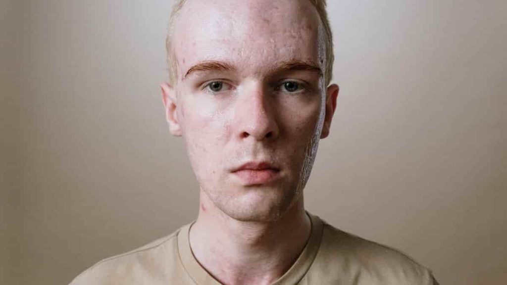 does pre workout cause acne